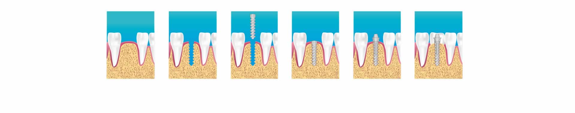 Implantes Dentales